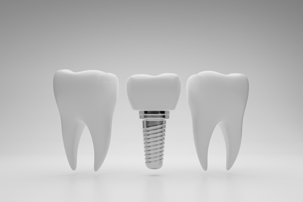 What To Expect During A Dental Implant Procedure: Step By Step