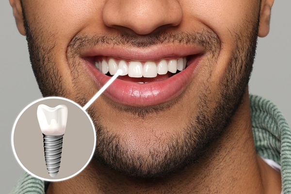 Why Choose Dental Implants Over A Dental Bridge?