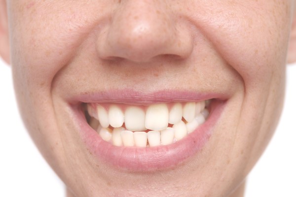 Teeth Straightening Treatments From A General Dentistry Office