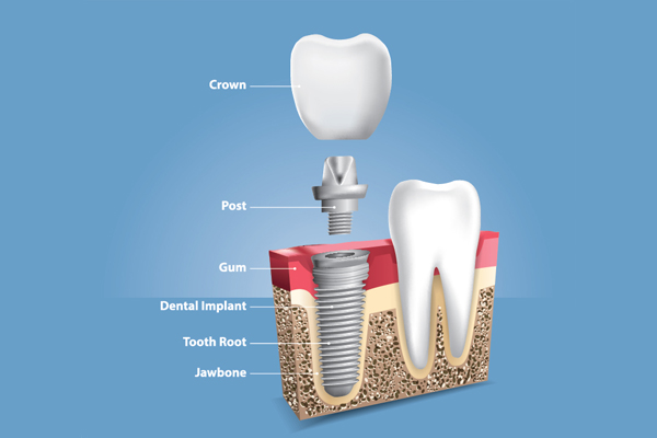How To Help Dental Implants Last A Long Time